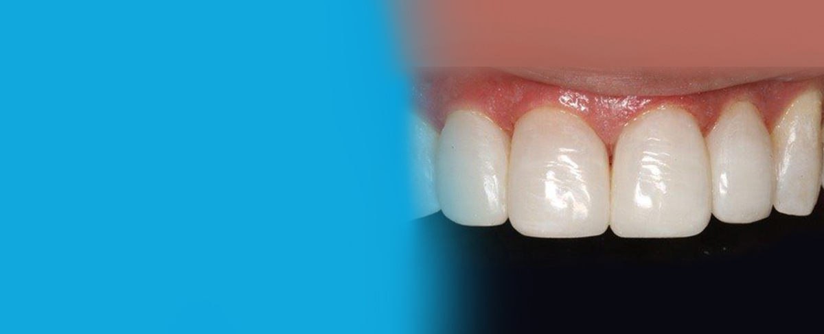 Direct Composite Veneers vs. Porcelain
