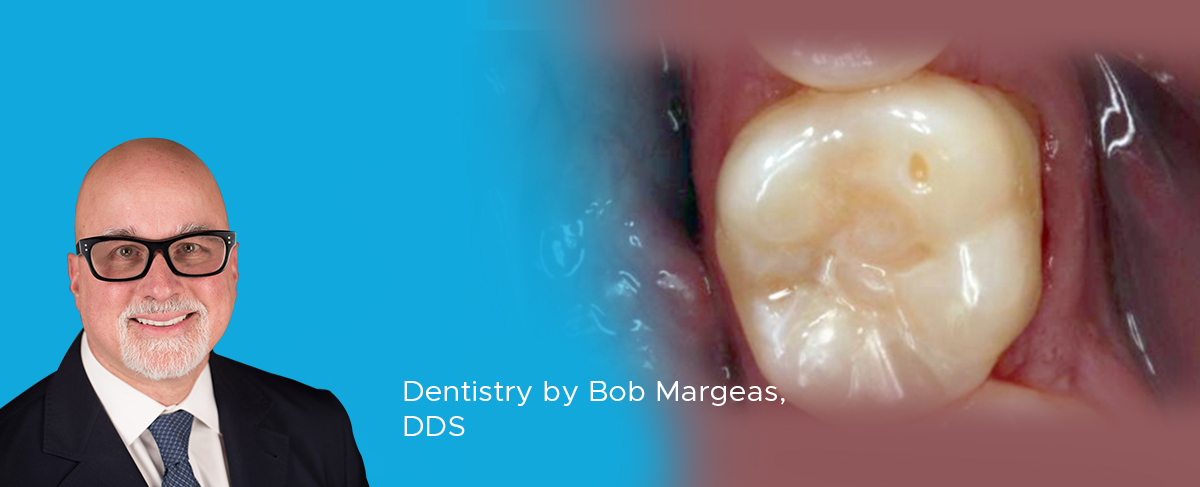 Clinical Article on Adhesive Dentistry