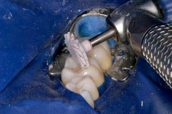 Figure 7: Use an A.S.A.P. Pre-Polisher to remove surface scratches.