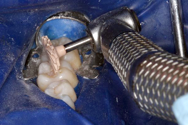 Figure 8: Apply light pressure using the A.S.A.P. Final High Shine Polisher to quickly bring an esthetic luster to the restoration. 20 seconds should do it!