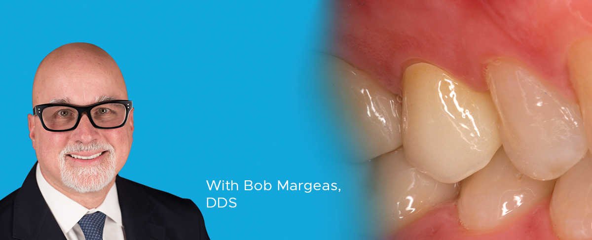 Dr-Margeas-Single-Crown-Article-Image clinical article banner Dr. Bob Margeas single crown