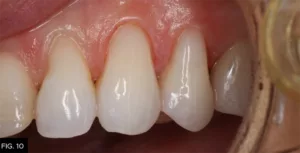 Class IV clinical final restoration