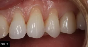 Class V clinical, before bonding, cuspid, bicuspid