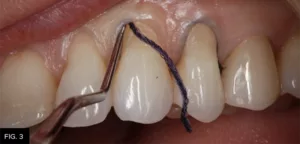 Class V clinical retraction cord