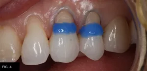 Class V clinicaladhesive bond, prep, microbrush