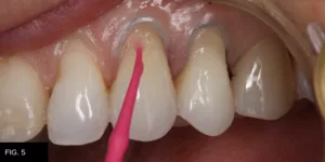 Class V clinical, adhesive bond, prep