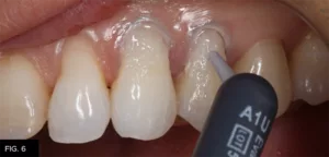 Class IV clinical, composite placement