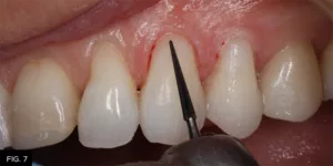 Class IV clinical, contour, restoration, finishing bur