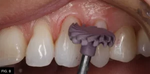 Class IV clinical, A.S.A.P. Pre-polisher