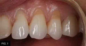 Class V clinical, lesions, cuspid, biscuspid