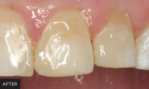 Dr. Lawson Anterior Restorations article - AFTER
