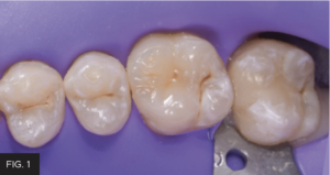 Dr. McClintock Class II Protocol article - FIG 1