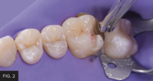 Dr. McClintock Class II Protocol article - FIG 2