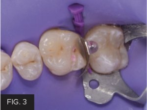Dr. McClintock Class II Protocol article - FIG 3