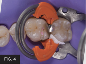 Dr. McClintock Class II Protocol article - FIG 4