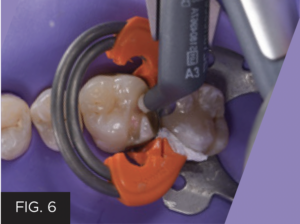Dr. McClintock Class II Protocol article - FIG 6