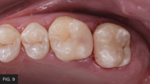 Dr. McClintock Class II Protocol article - FIG 9