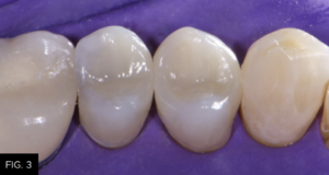 final polisher occlusal view