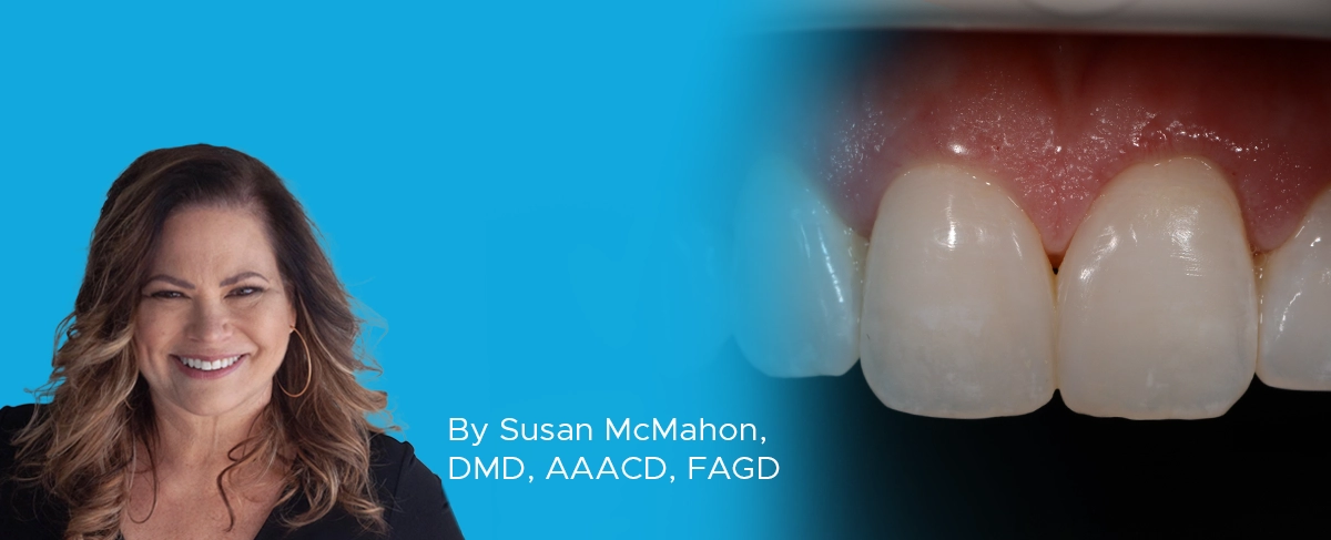 Dr-McMahon-Gingival-Sculpting-Article-Image Dr. McMahon Gingival Sculpting article banner