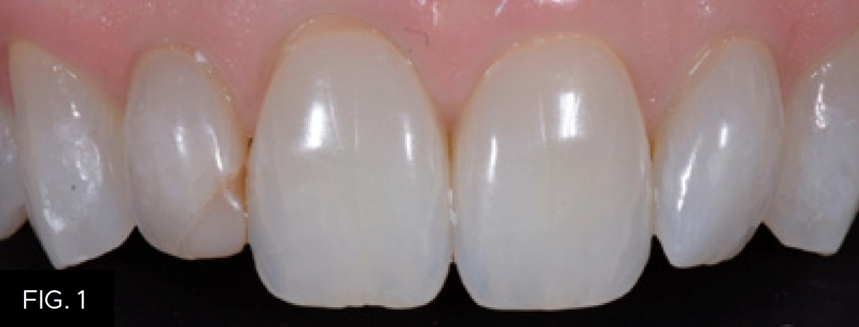 existing composite on #7 tooth