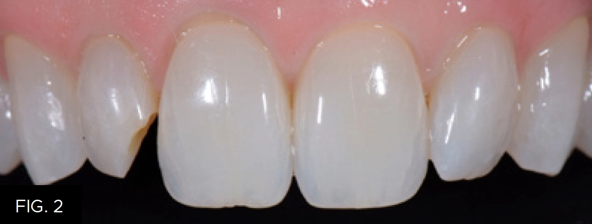 removal existing composite