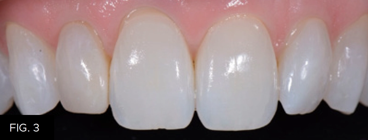 final composite restoration