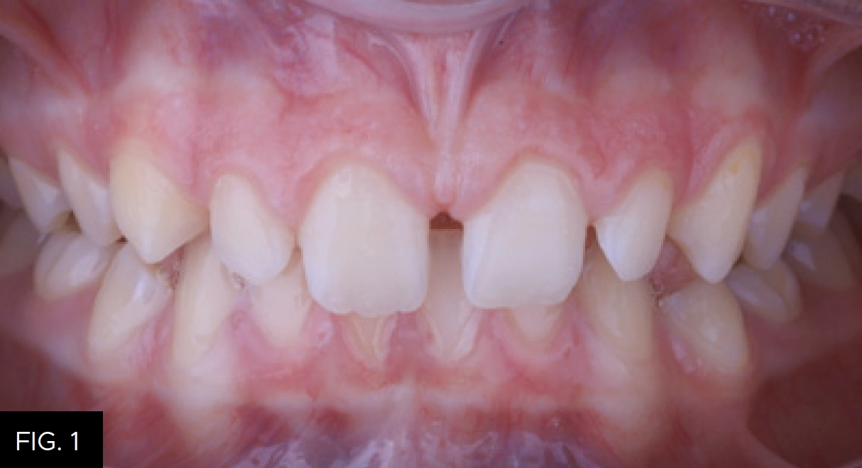 Patient premaxillary anterior microdontia and spacing with deep bite