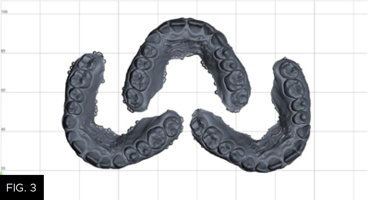 STL files for printing of wax-up models