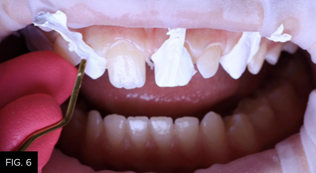 PTFE tape applied to teeth