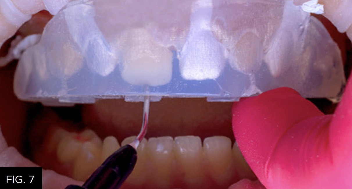 Evanesce Flow injected