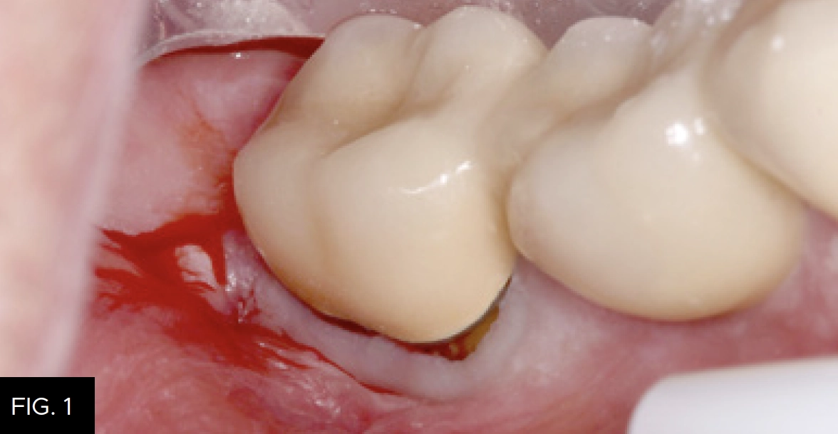 mesial buccal decay crown tooth