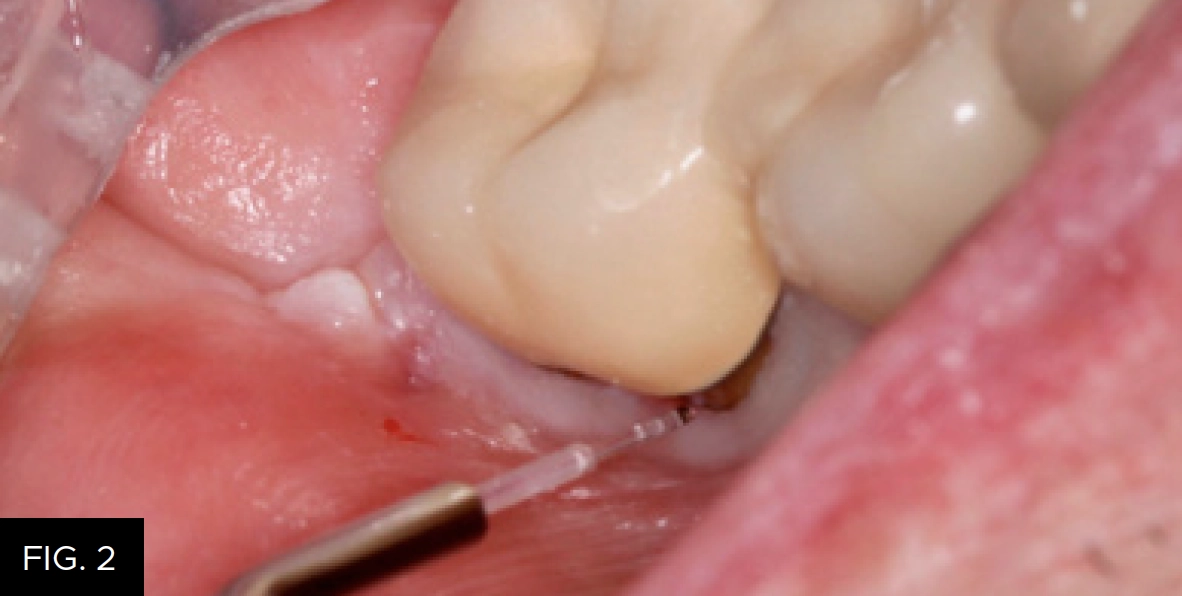 4mm Bluewave laser fiber tip