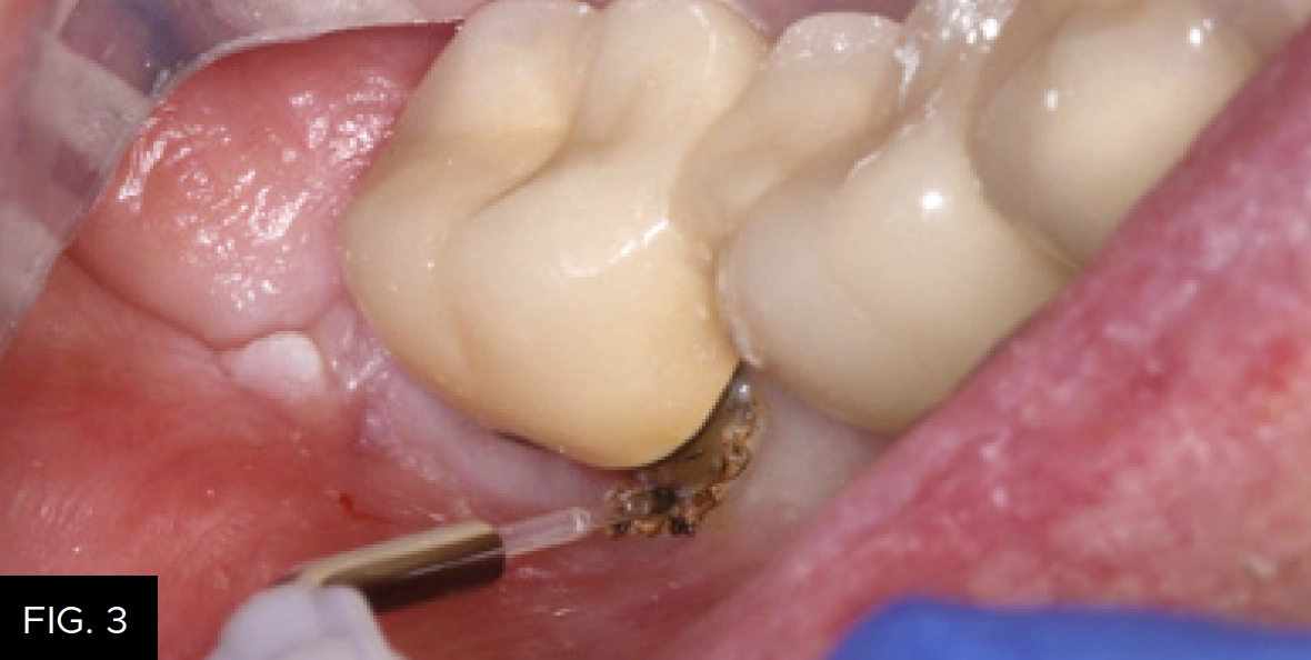 Bluewave laser control hemostasis