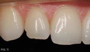 retracted right lateral view