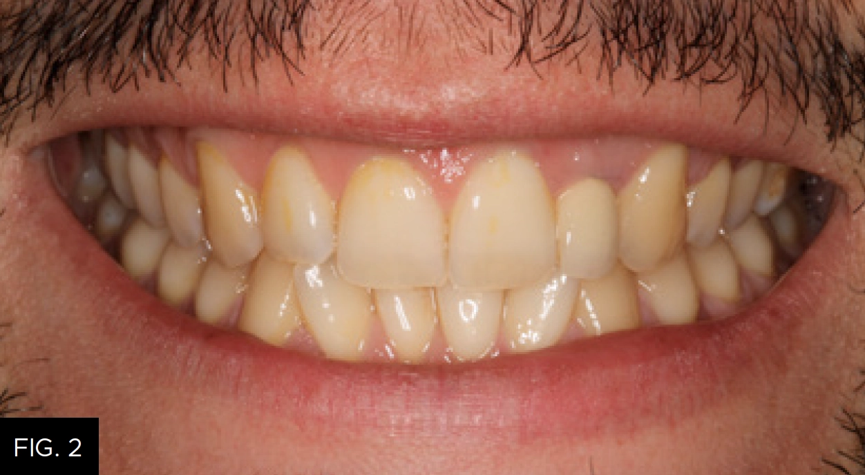 pre-op frontal smile view