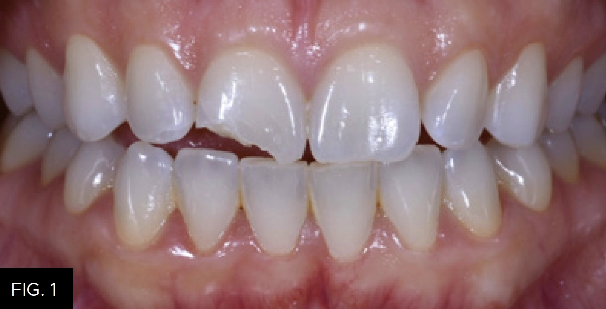 pre-op tooth #8 occlusal assesment