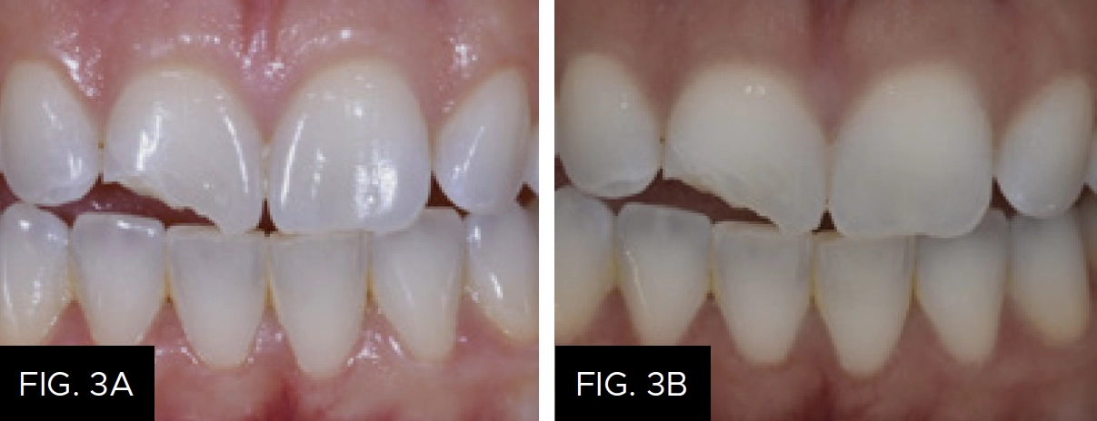polarized lens, no reflection, better visualization of surface, tooth characterizations