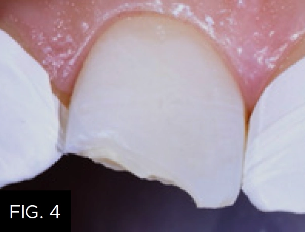 teflon tape fractured tooth isolation