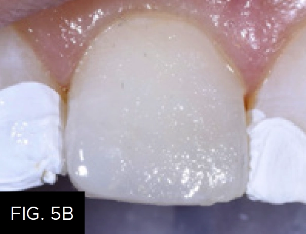 lingual shelf layers