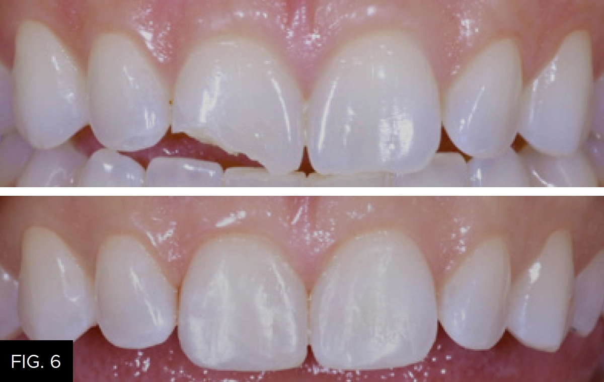 highly esthetic composite restorations