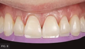 lingual shell, A2D composite