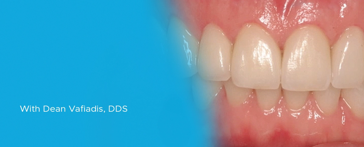 FMR-Article-Image Full Mouth Rehabilitation program article banner