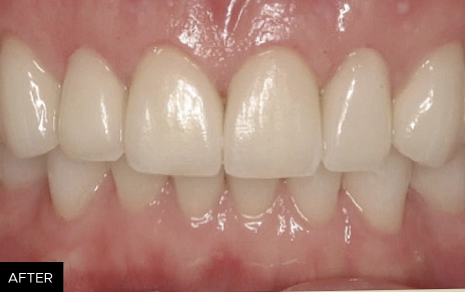 FMR course, restoration after clinical