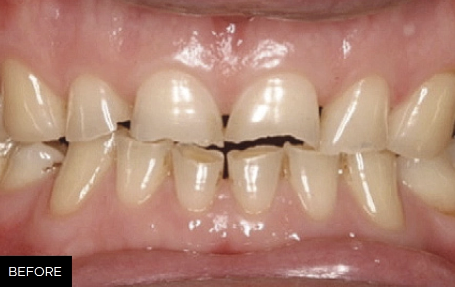 FMR course, before restoration clinical