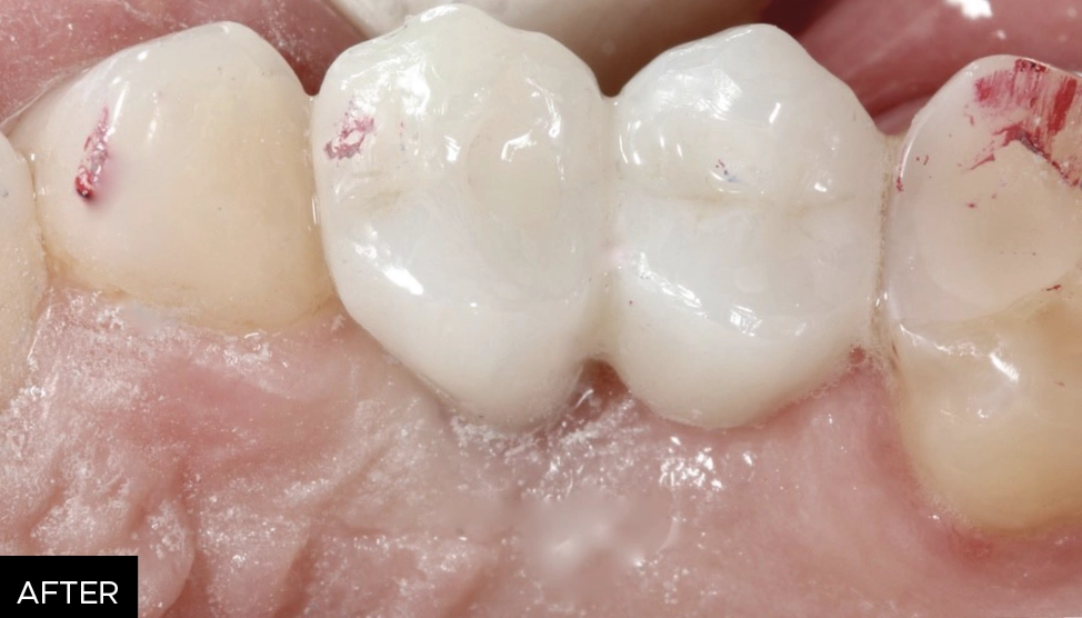 adjusted surface, zirconia restoration post-adjustment