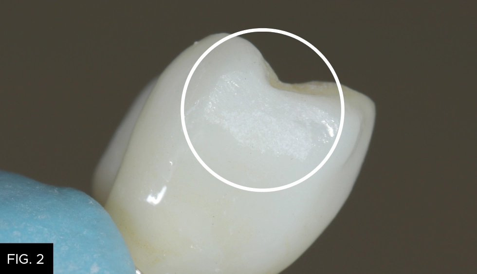 diamond bur, scratch removal