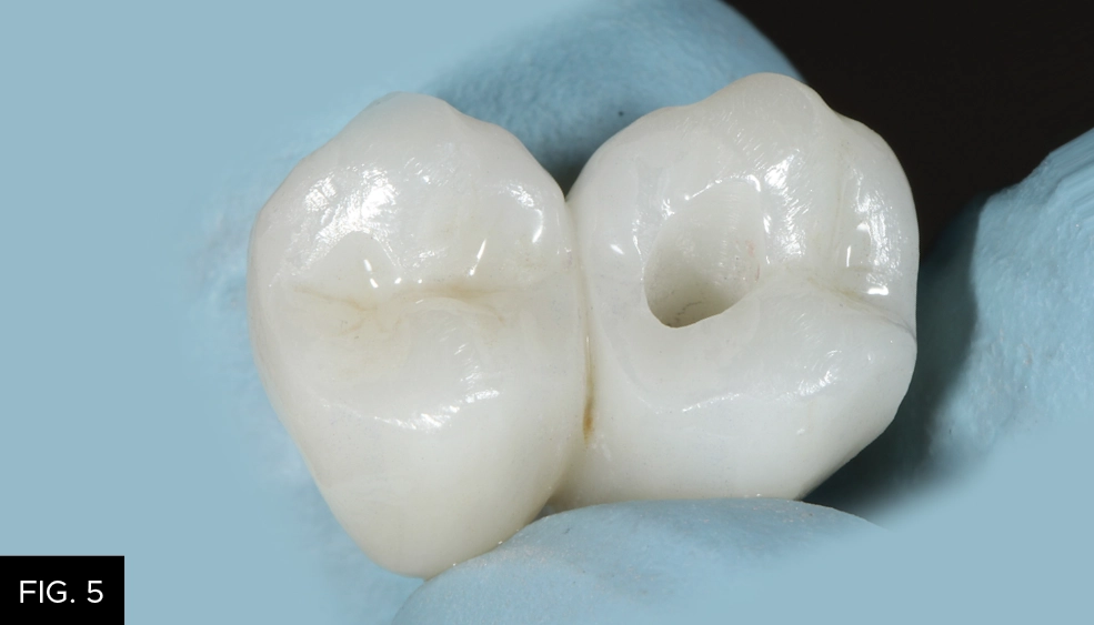 zirconia adjustments
