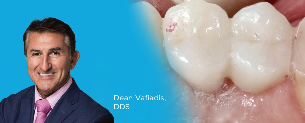 Dr-Vafiadis-Ask-Expert-Article-Image Dr. Vafiadia, zirconia restorations article banner