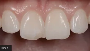 mesio-incisal fracture tooth #8