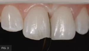 steel sectional matrix band, proximal surface